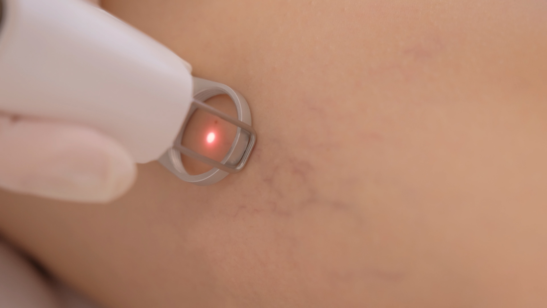 Poliklinika Bagatin Quanta laser 5
