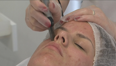 Dermapen 9
