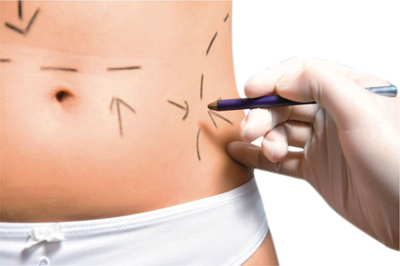 Poliderma Intralipoterapia 1